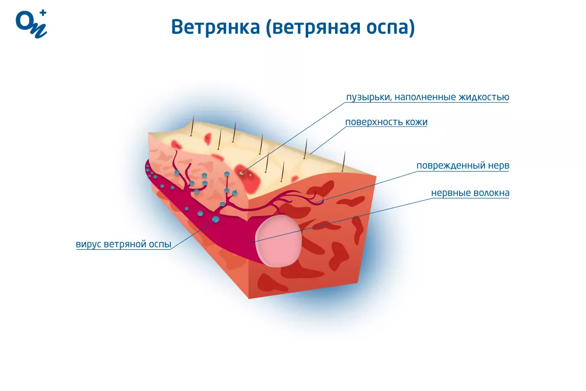 Ветрянка (ветряная оспа), причины, симптомы, лечение