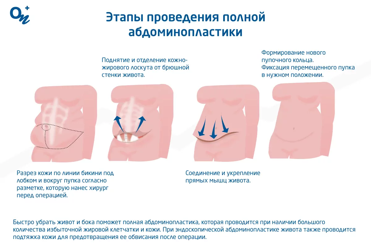 Почему появляется живот и как его убрать — блог медицинского центра ОН  Клиник