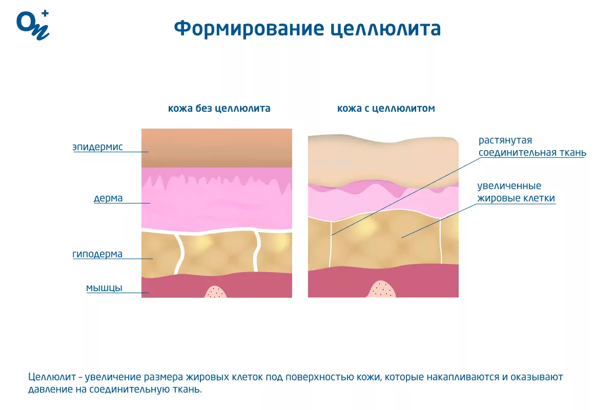 Болезнь Пейрони