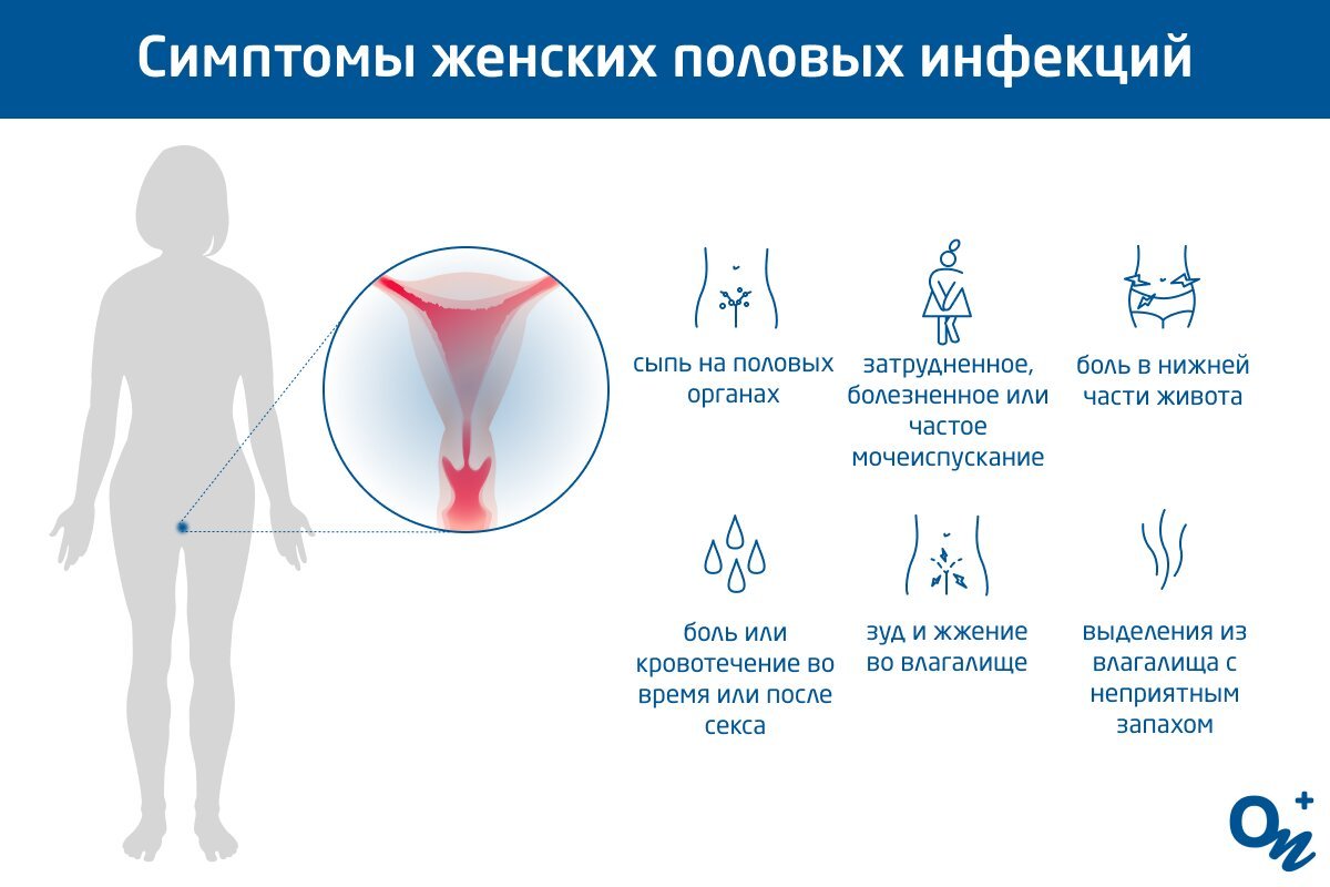Симптомы женских половых инфекций