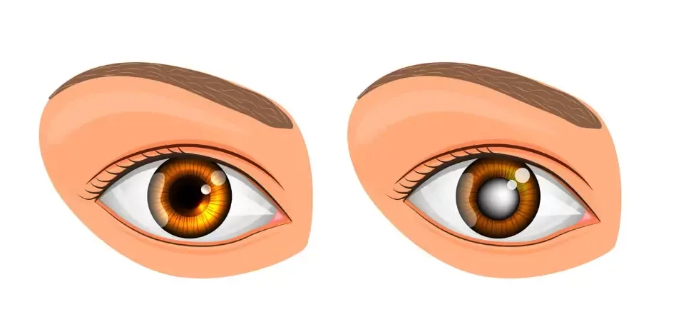 Здоровый глаз и глаз с глаукомой