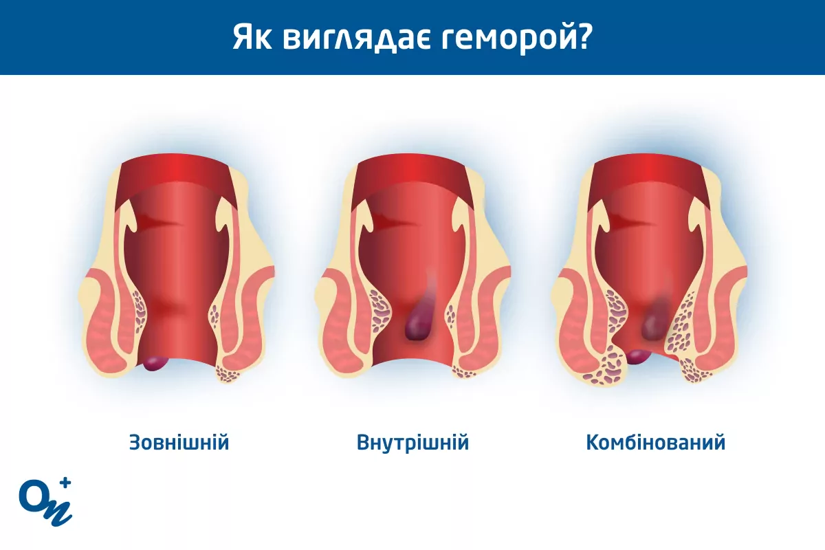 Последствия анального секса – о чем свидетельствуют научные факты?