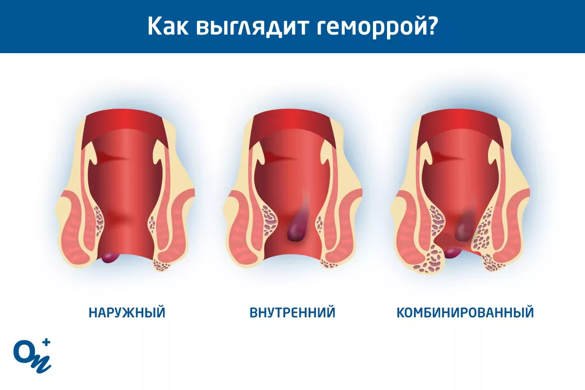 Лечение геморроя в Днепре — проктология ОН Клиник Днепр