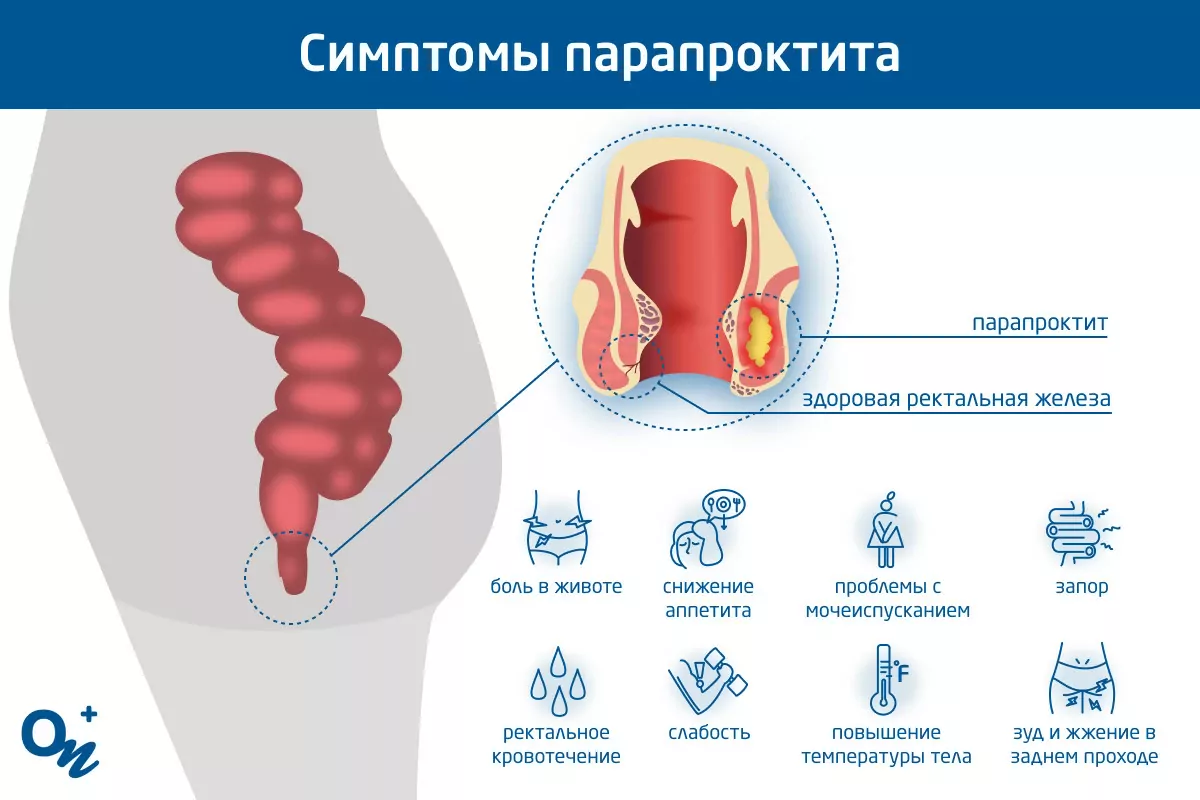 Боль после анального секса