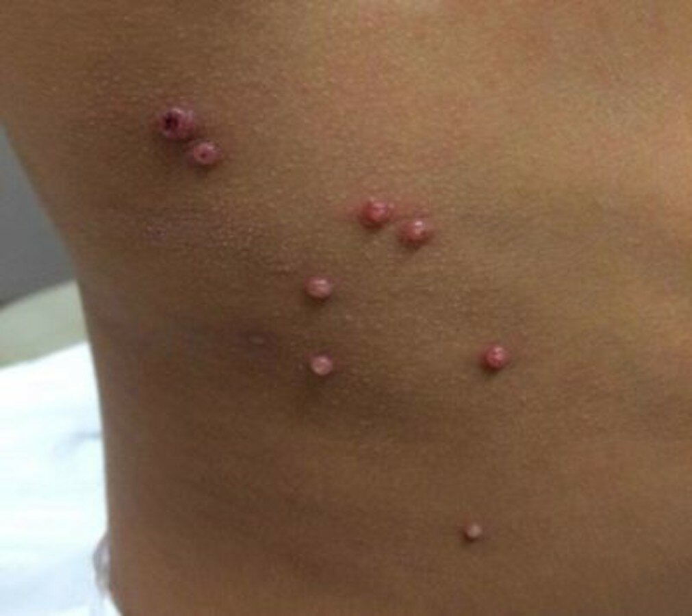 контагіозний молюск на шиї