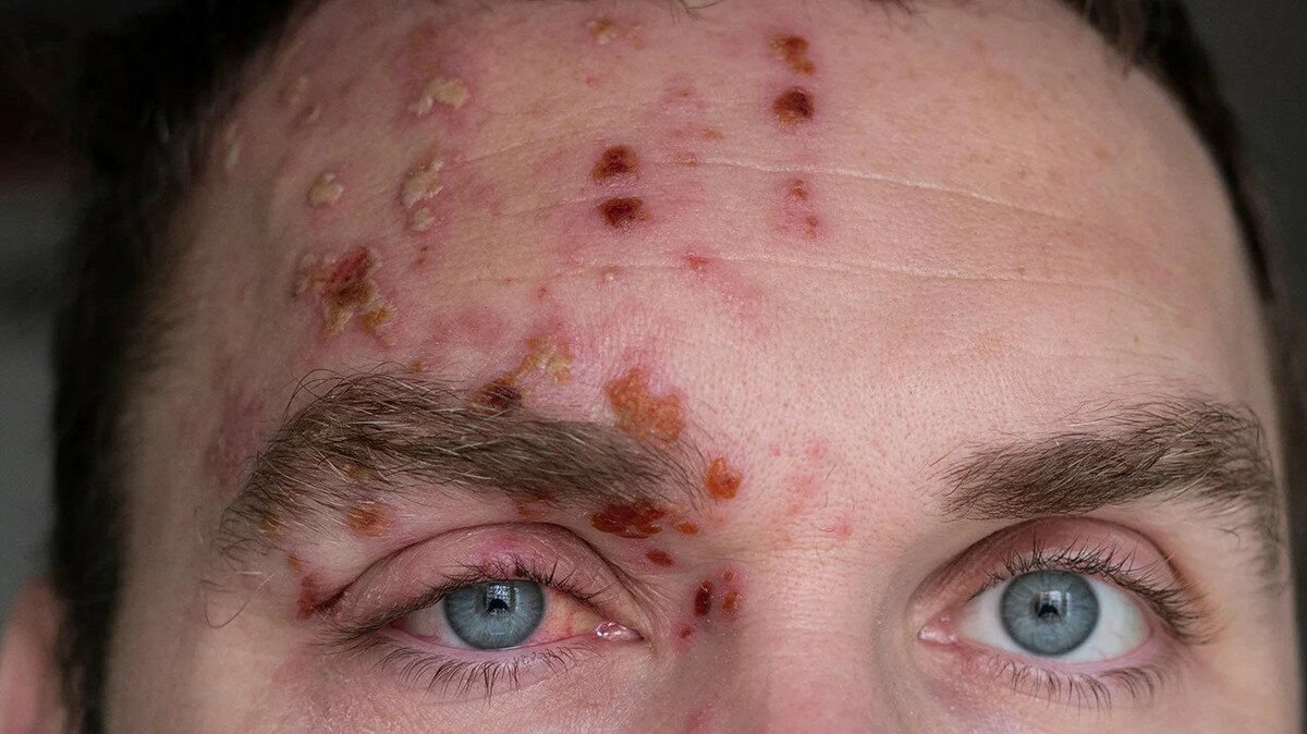 Shingles on the face