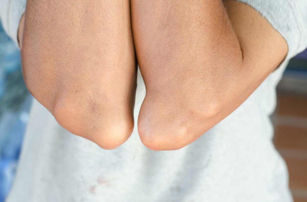 Подагра на лікті