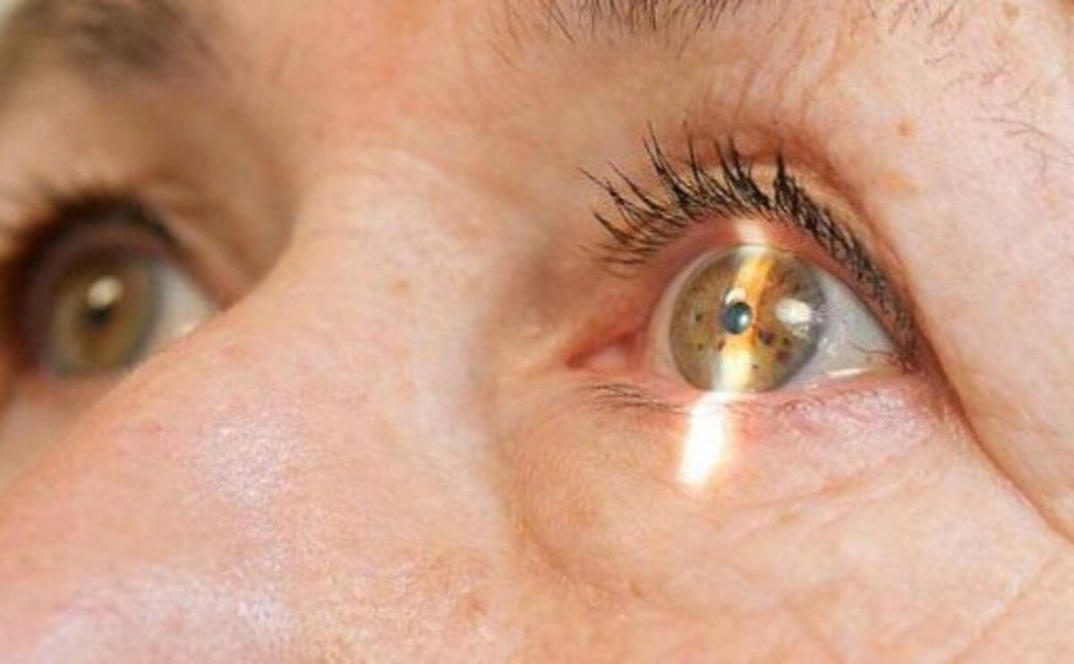 Начальная катаракта глаза