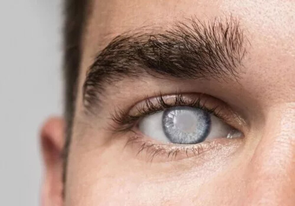 Незрелая катаракта глаза