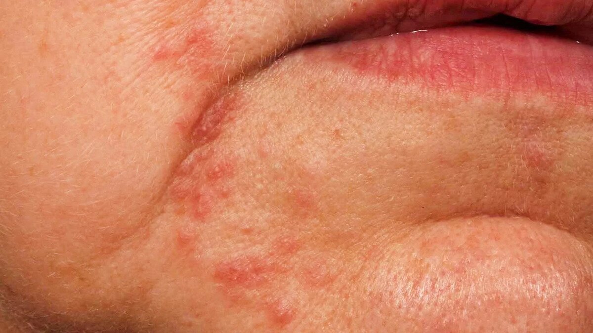 Сыпь на лице при заболевании печени