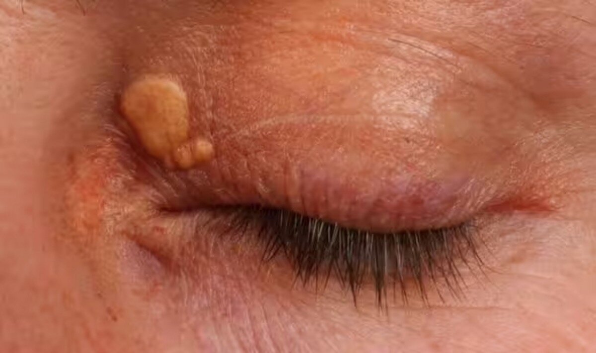 Воскоподібні шишки на повіках при захворюванні печінки