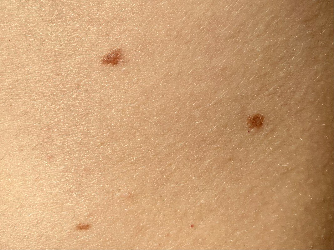 Нормальные родинки