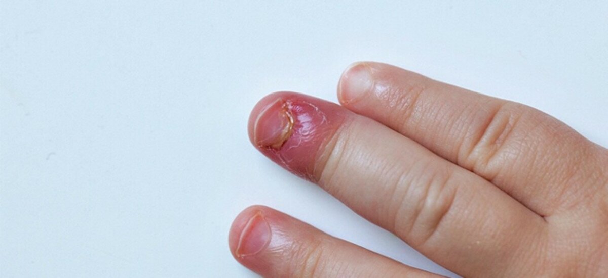 Панарицій у дитини