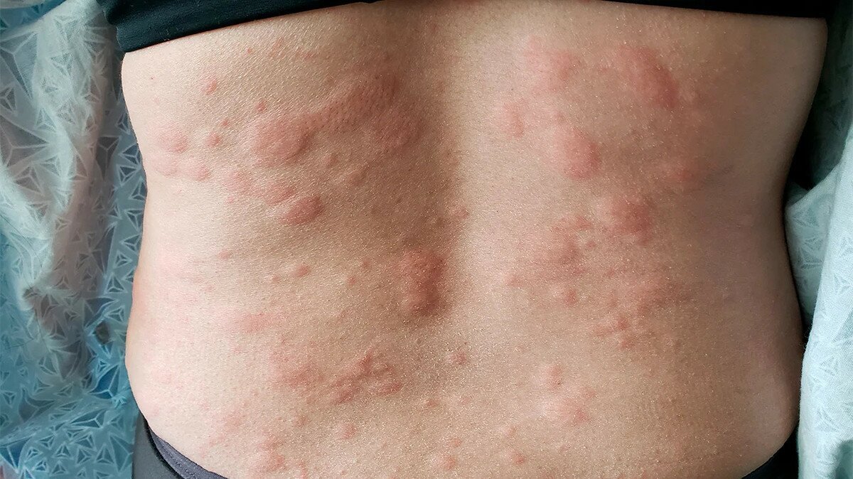 Висип на спині в разі алергії