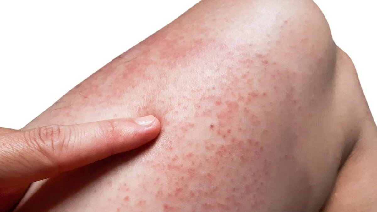 Сыпь на ноге при аллергии