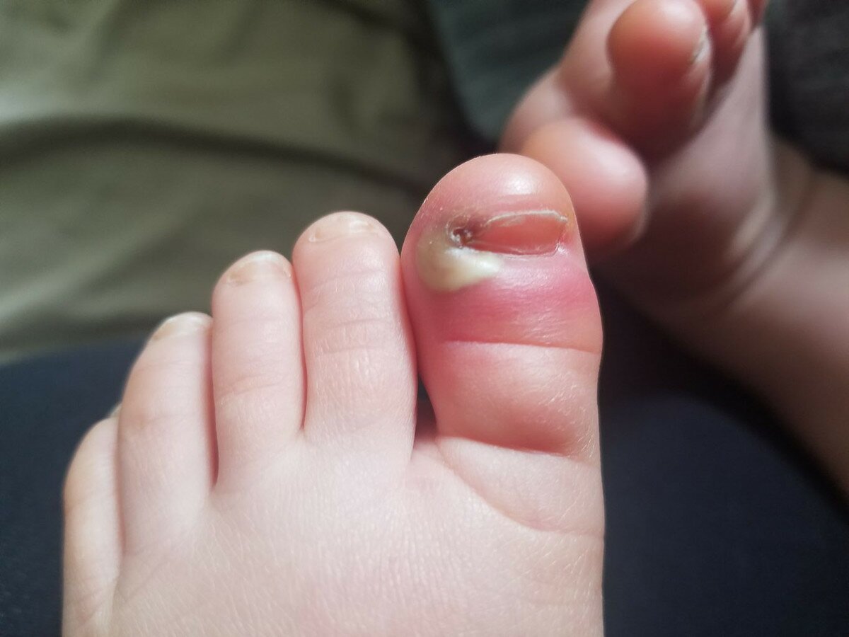 Панарицій на нозі в дитини