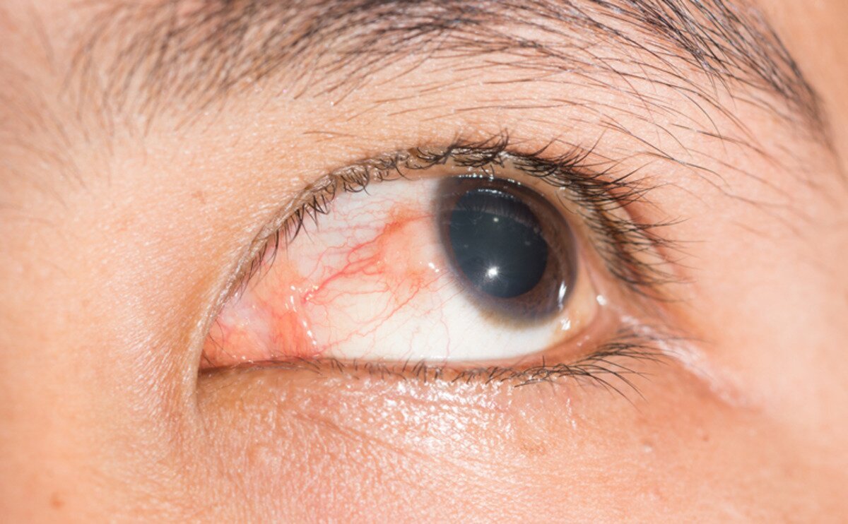 Inflammation of the eye in Crohn's disease