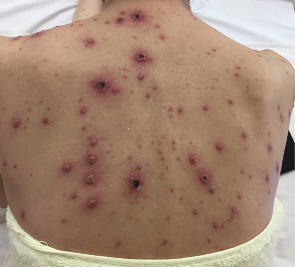 Гангренозная ветрянка