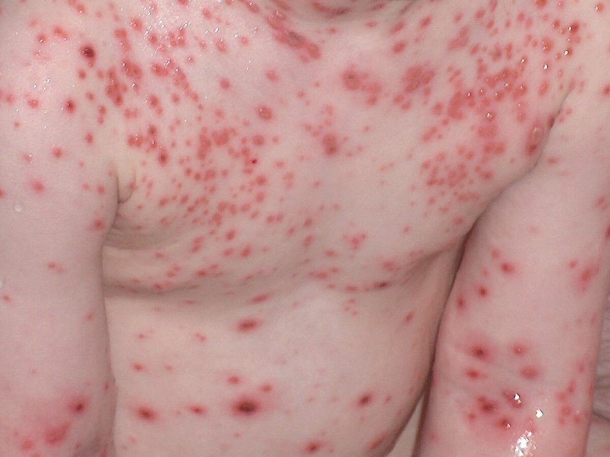 Генерализованная ветрянка