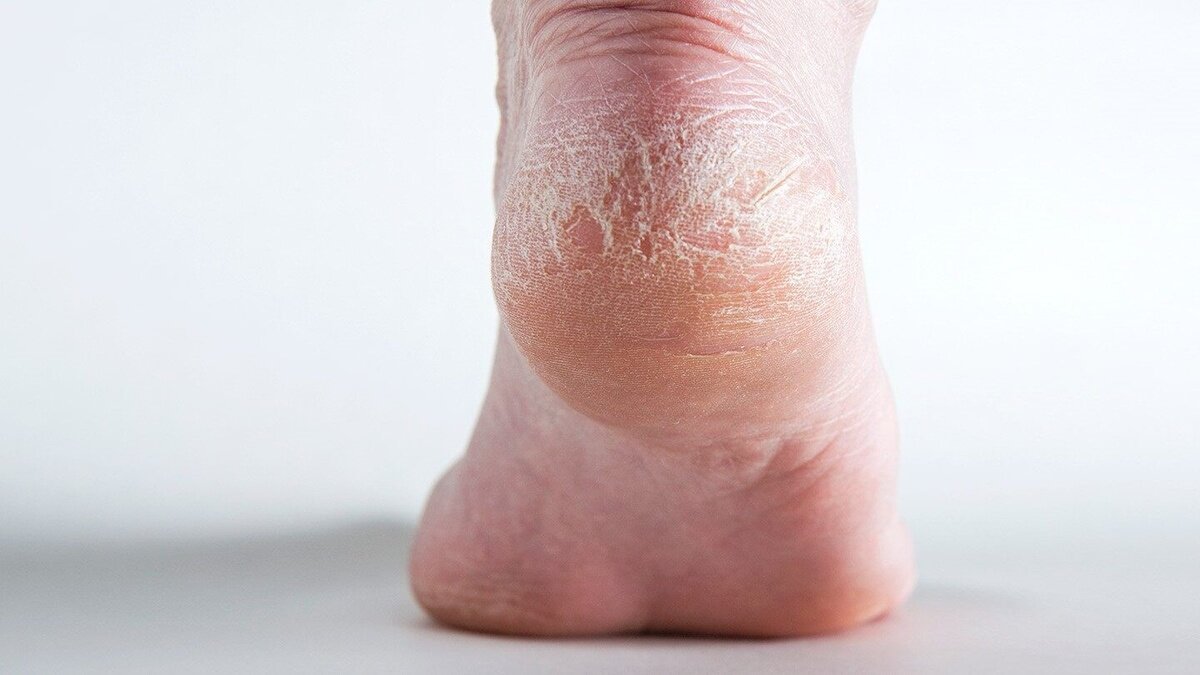 Псориаз на пятках