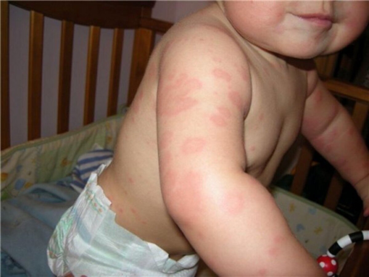 Крапивница у детей