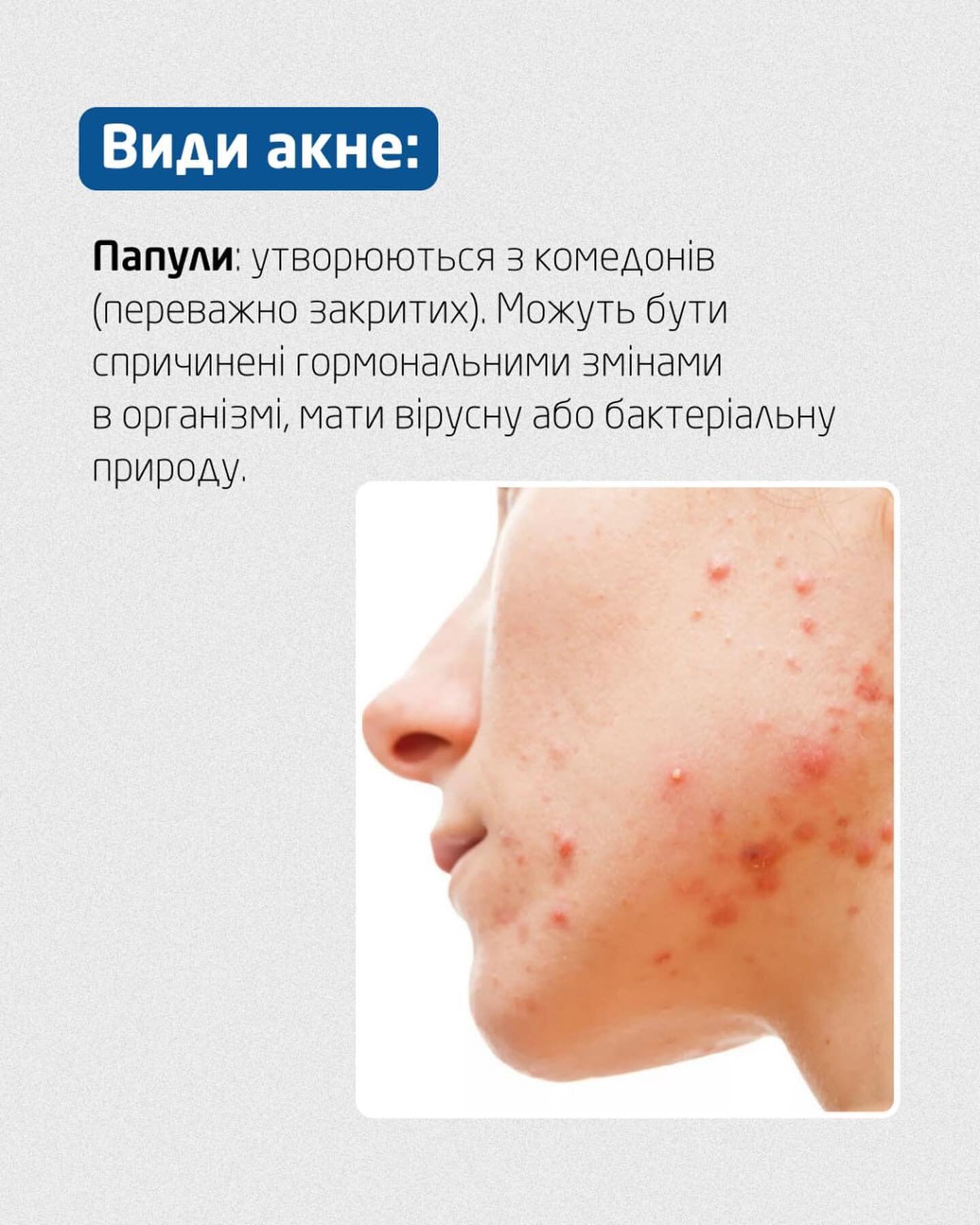 Папули при акне