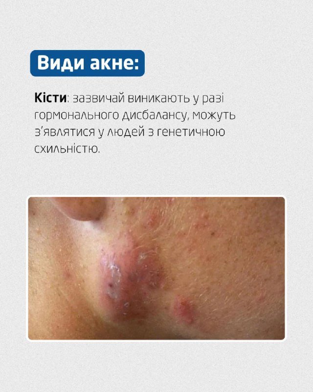 Акне у вигляді кісти