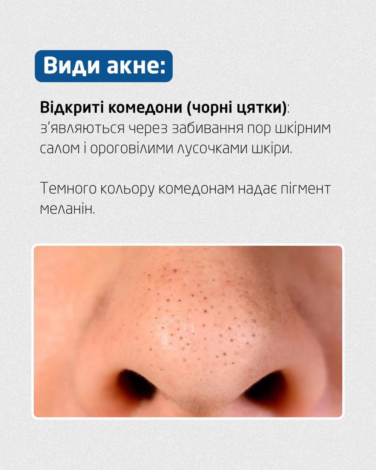 Відкриті комедони (чорні цятки)