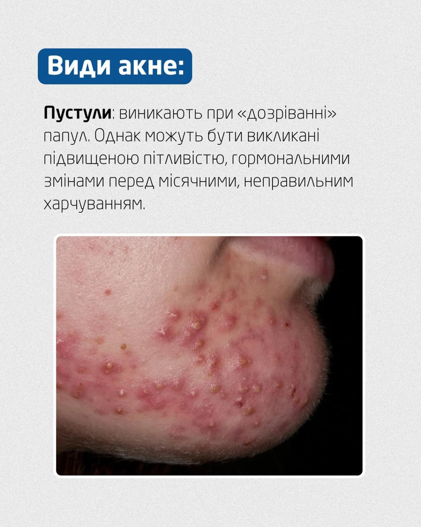 Пустули при акне