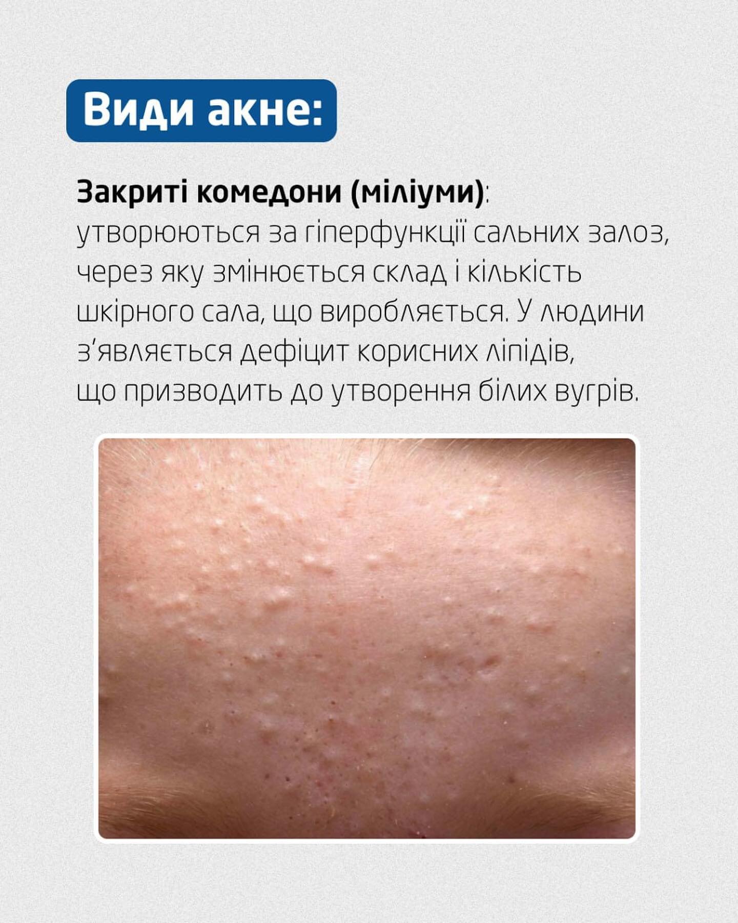 Закриті комедони (міліуми)