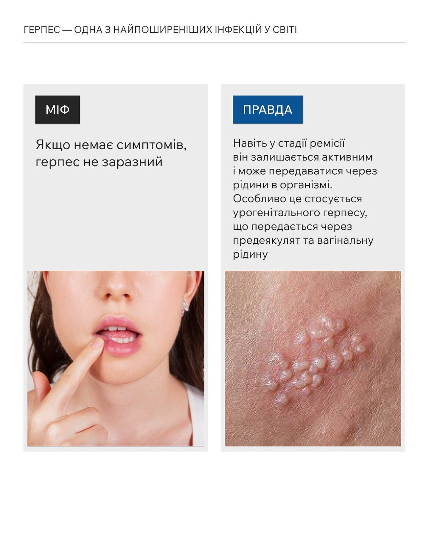 Чи безсимптомний герпес є заразним?