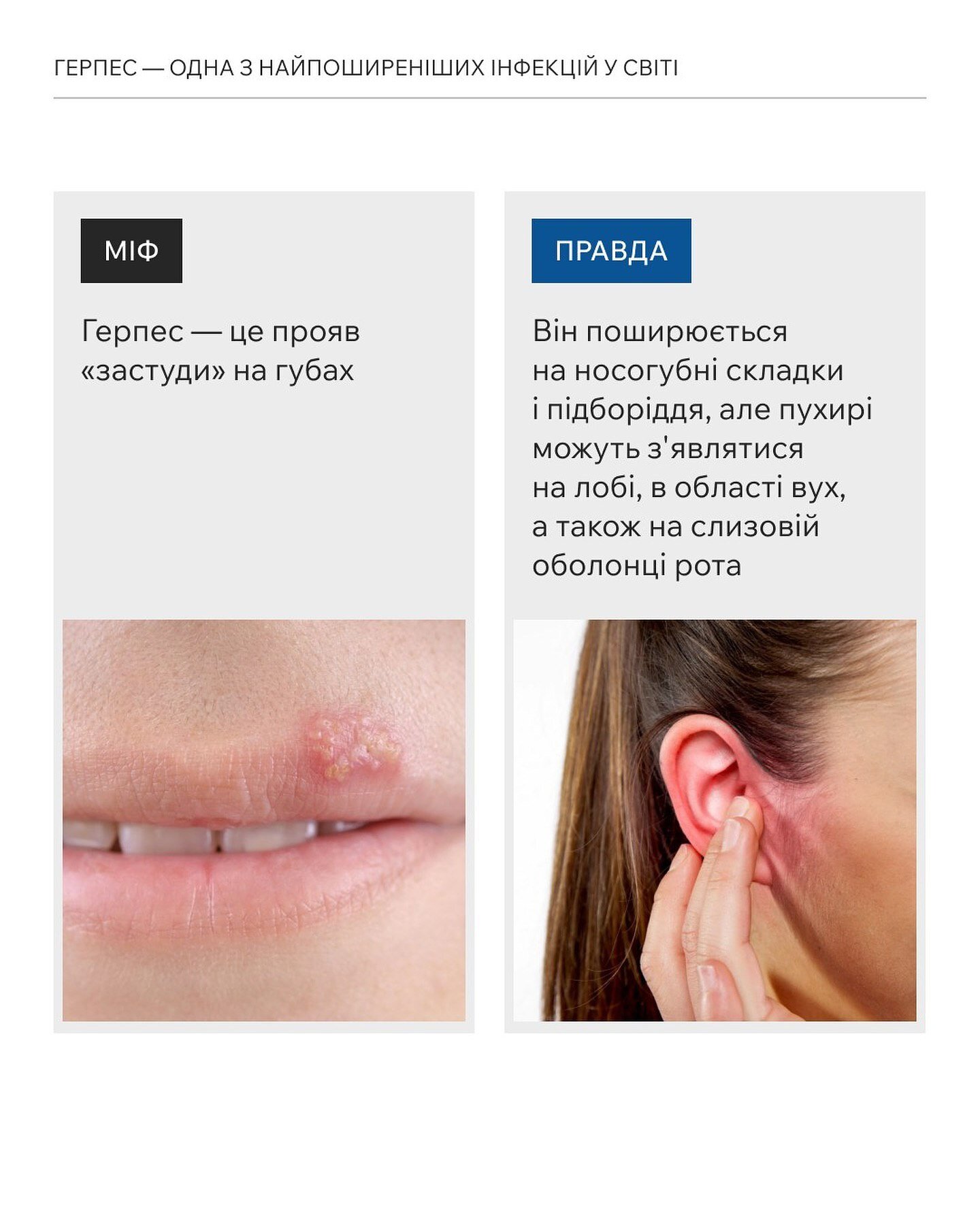 Герпес буває тільки на губах?