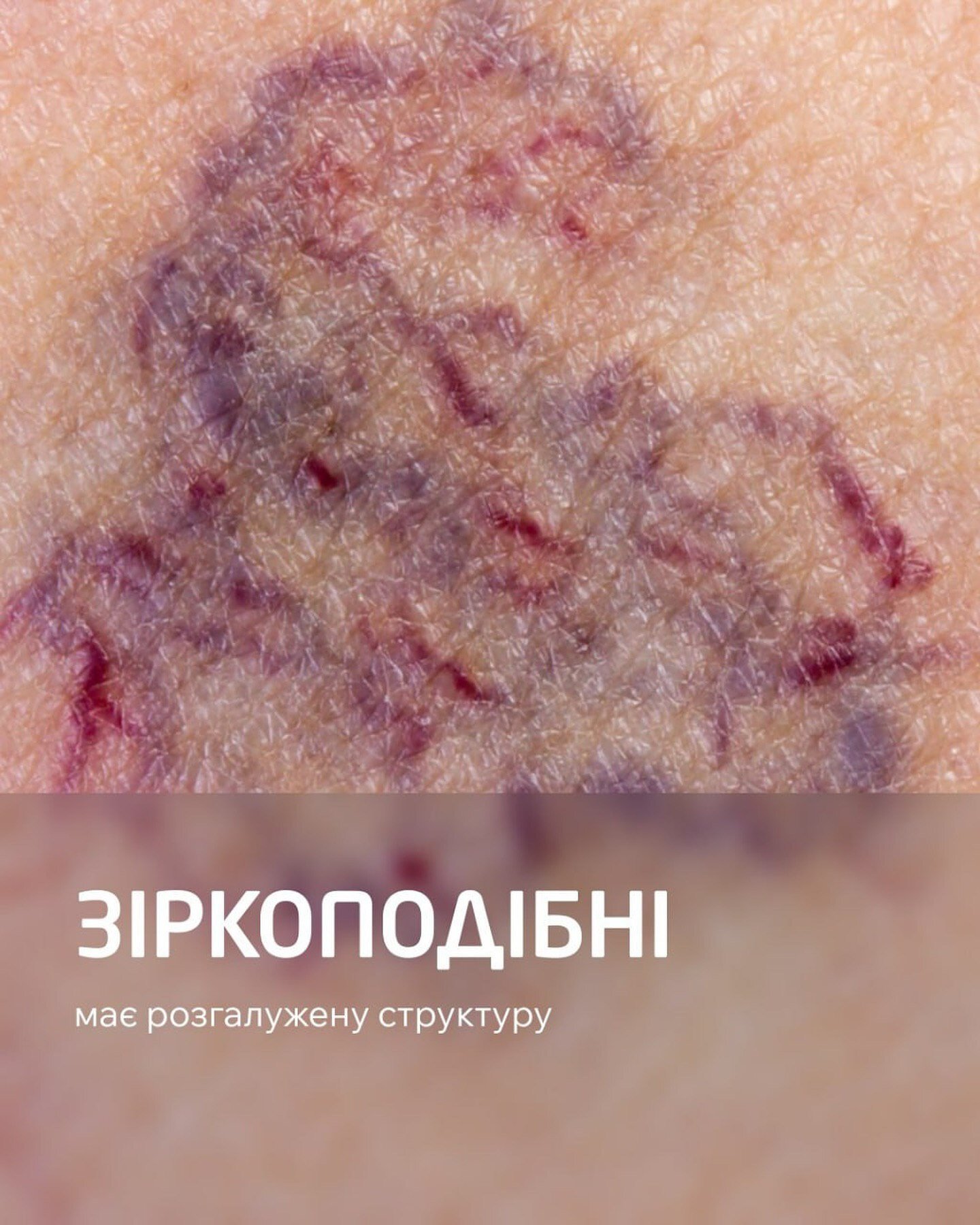 Зіркоподібна сіточка на ногах