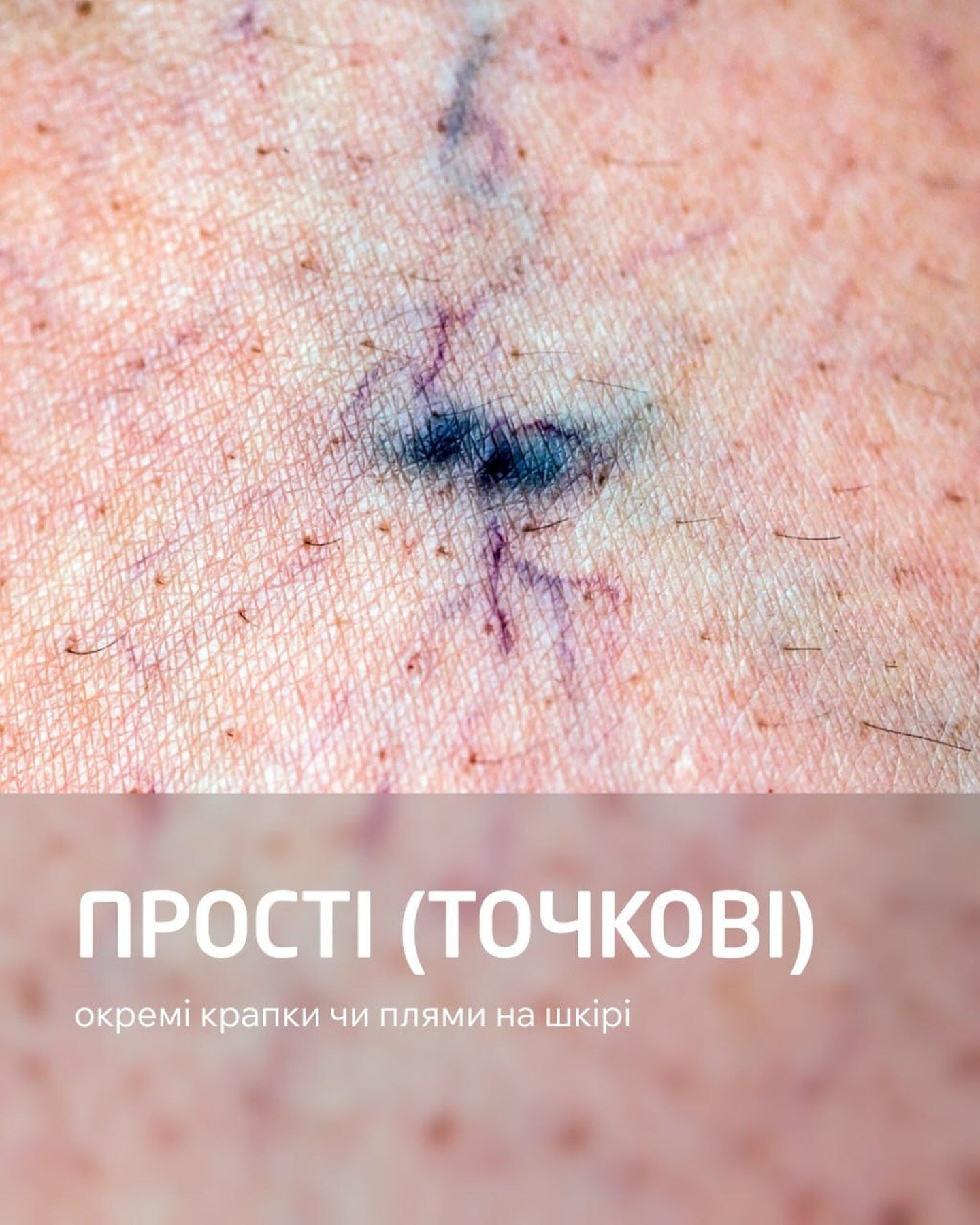 Проста (точкова) судинна сітка на ногах