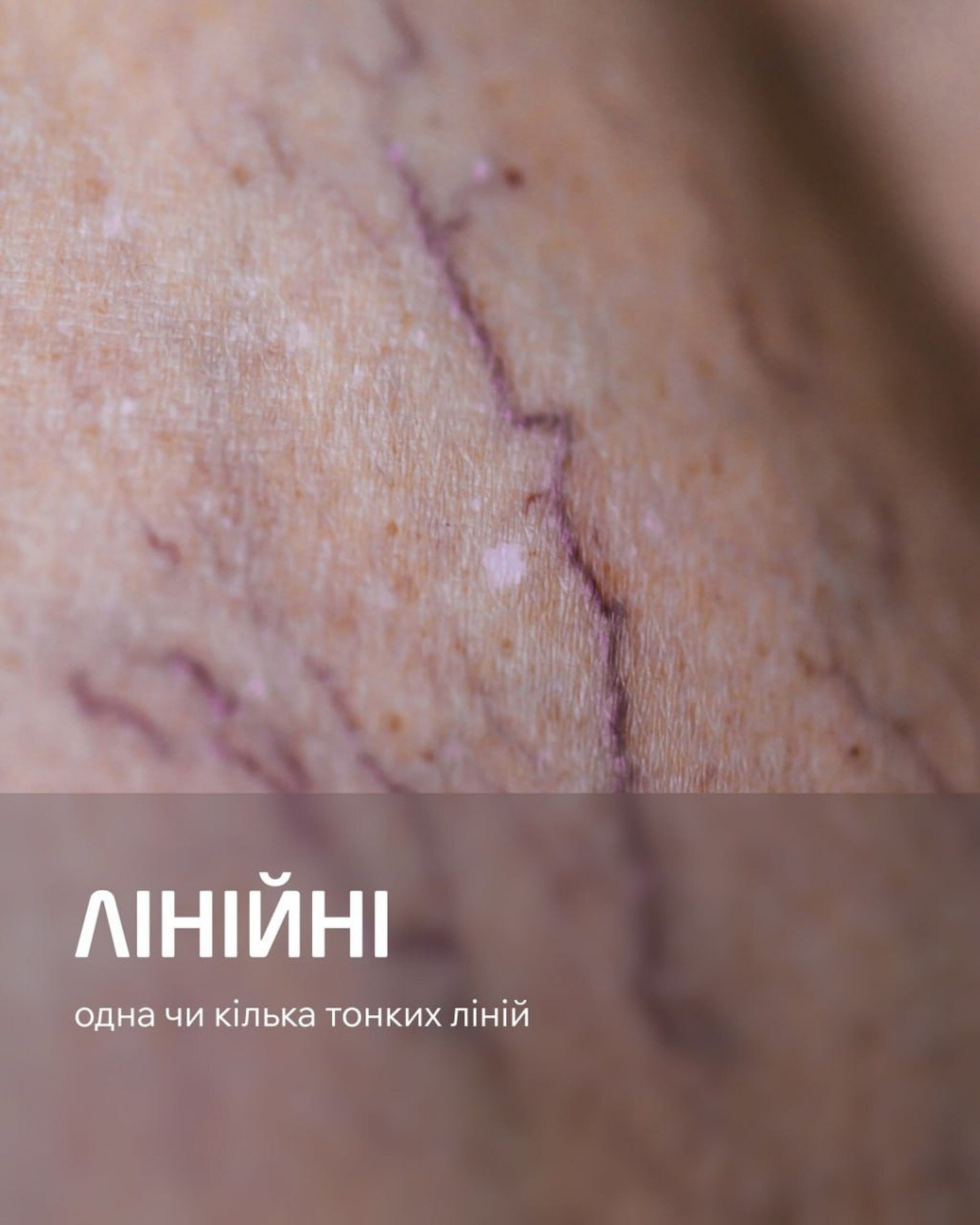 Лінійна судинна сітка на ногах