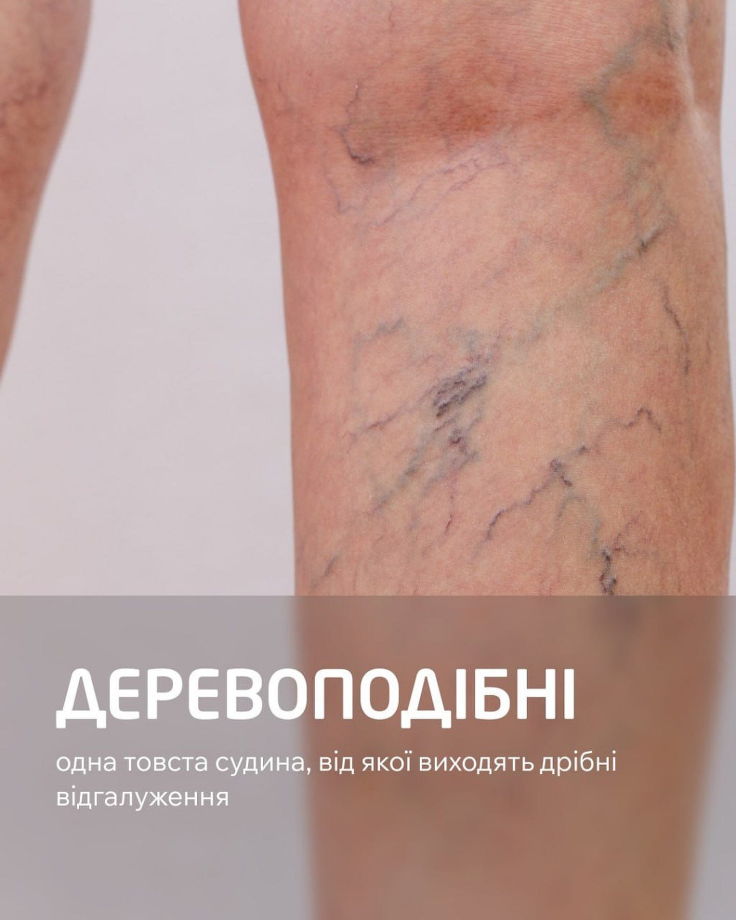 Деревоподібна судинна сітка на ногах