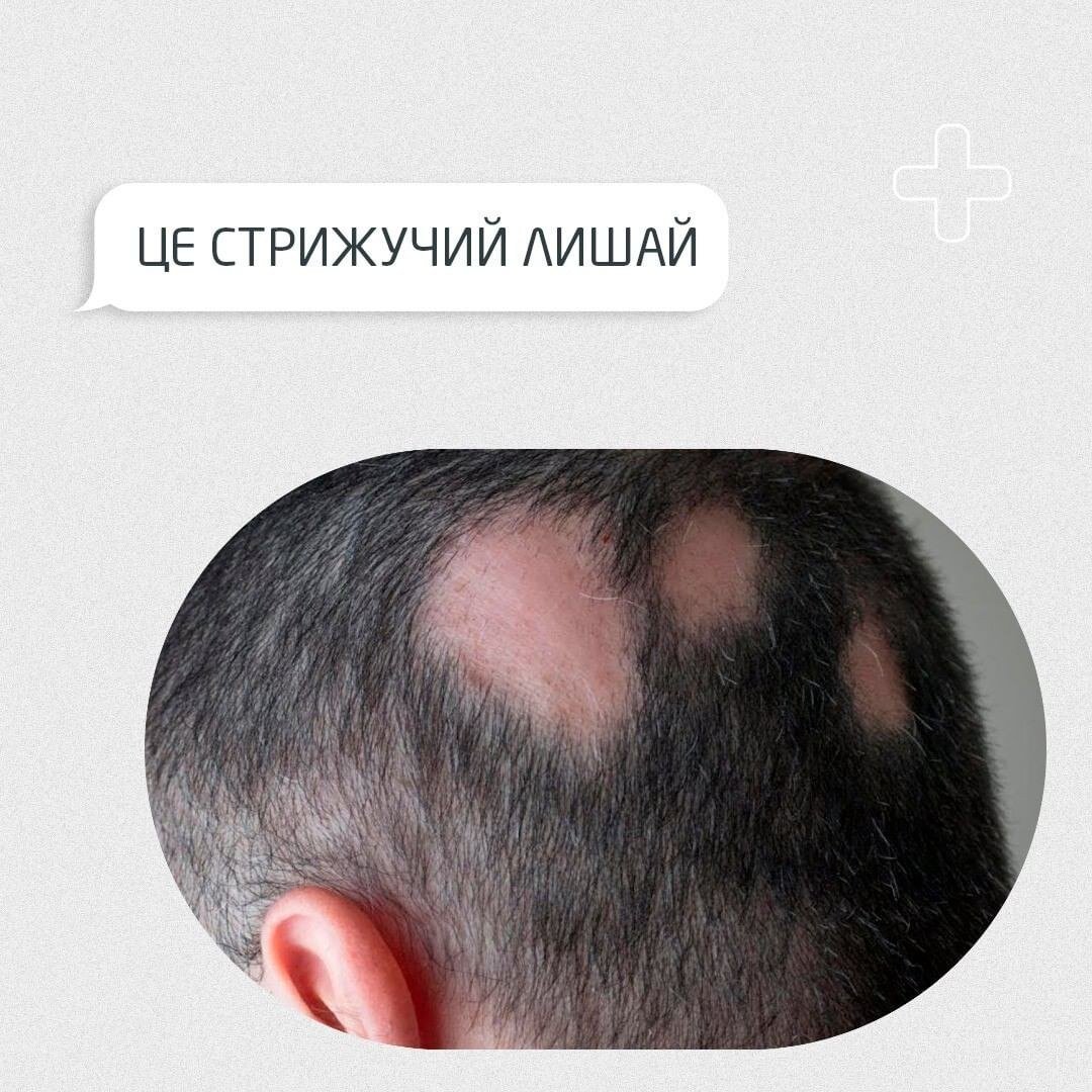 Стригучий лишай