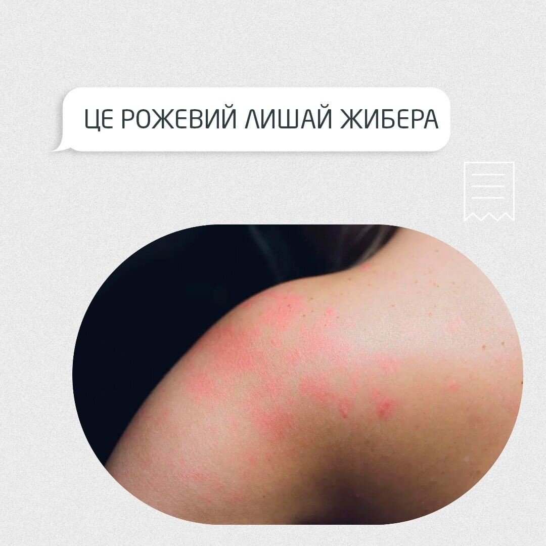 Рожевий лишай (Жибера)