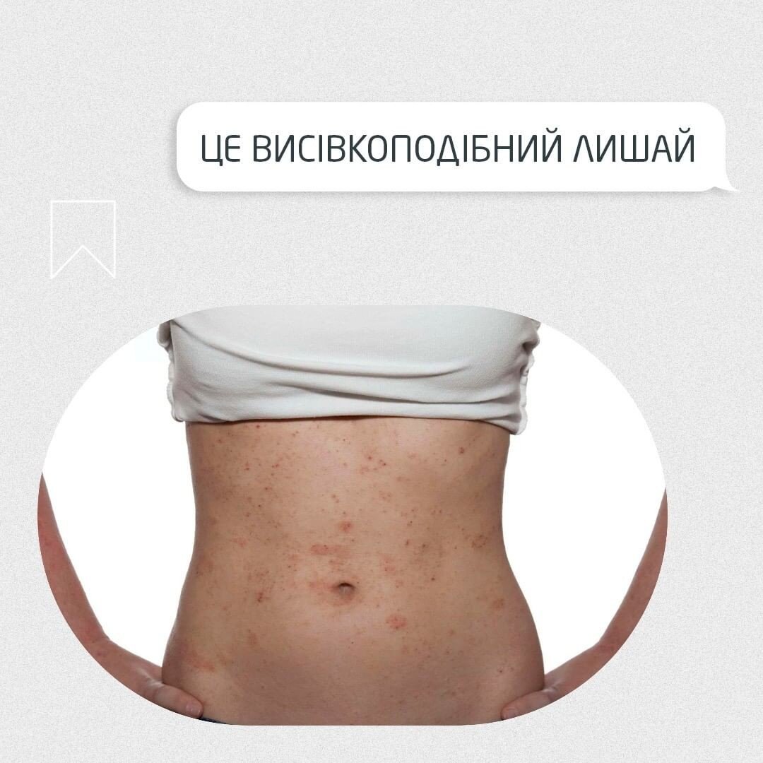 Висівкоподібний лишай