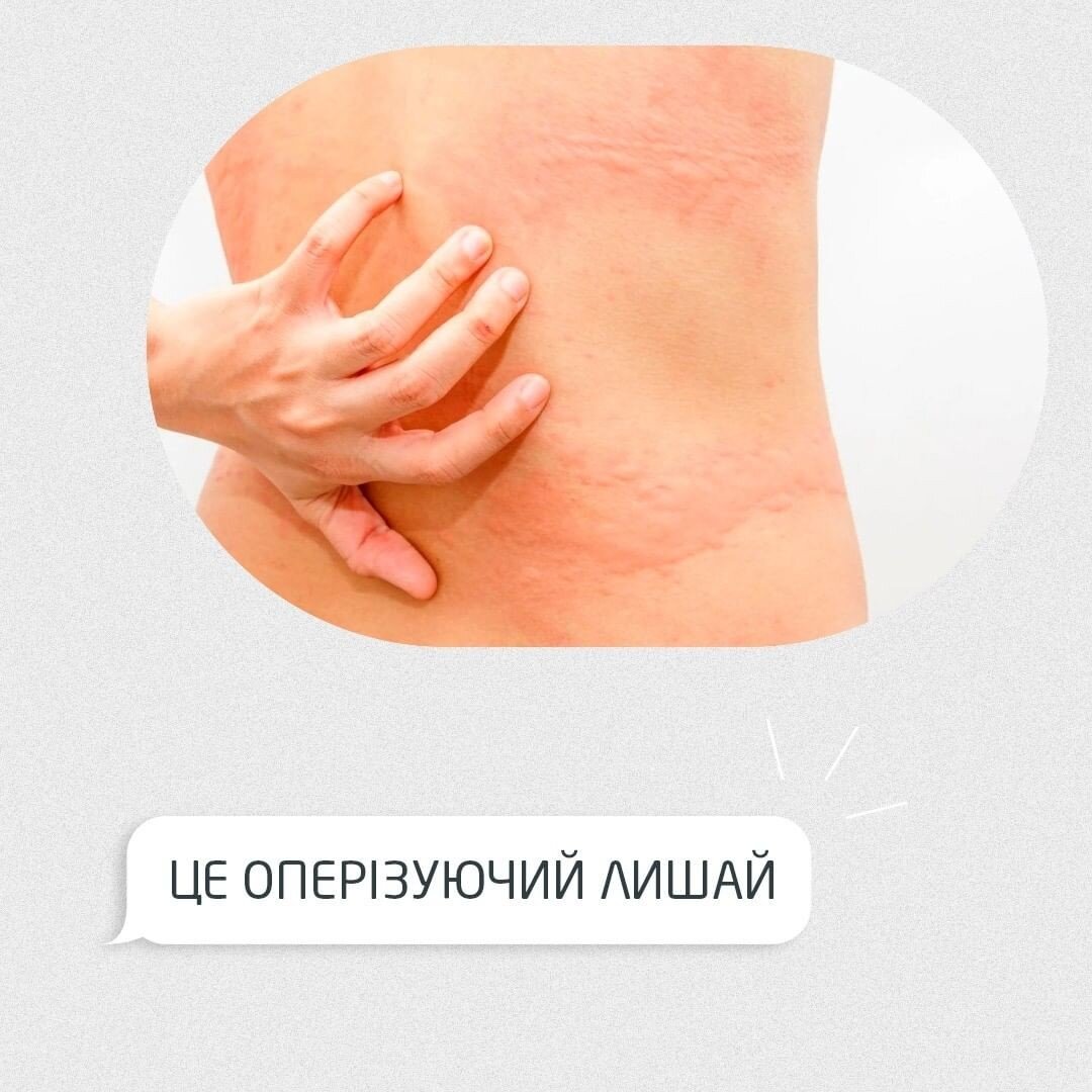 Оперізувальний лишай