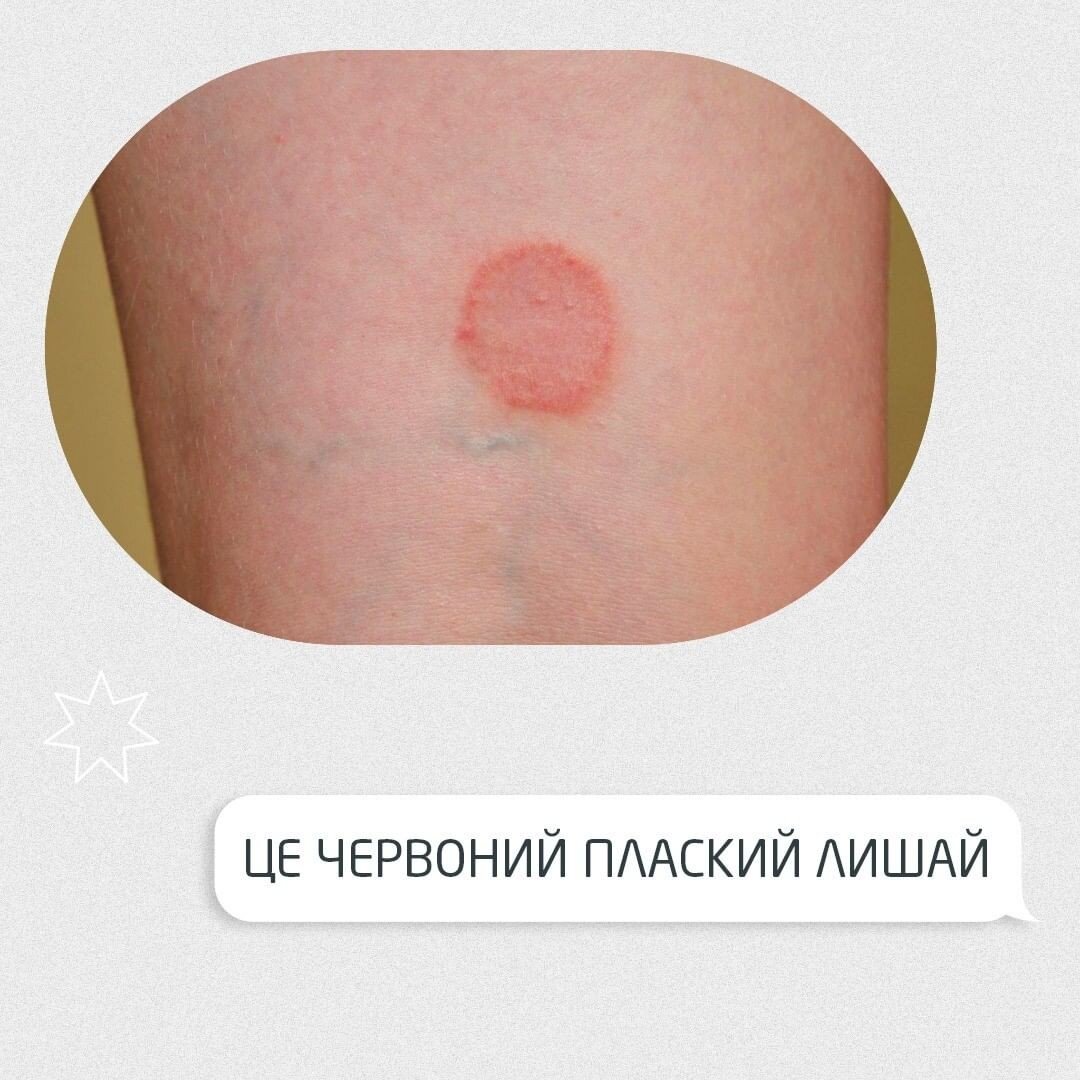 Червоний плоский лишай