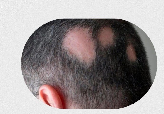 Стригущий лишай