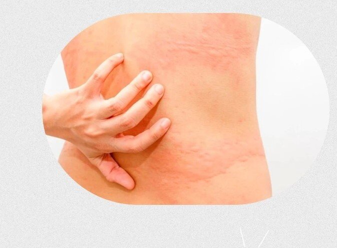 Опоясывающий лишай