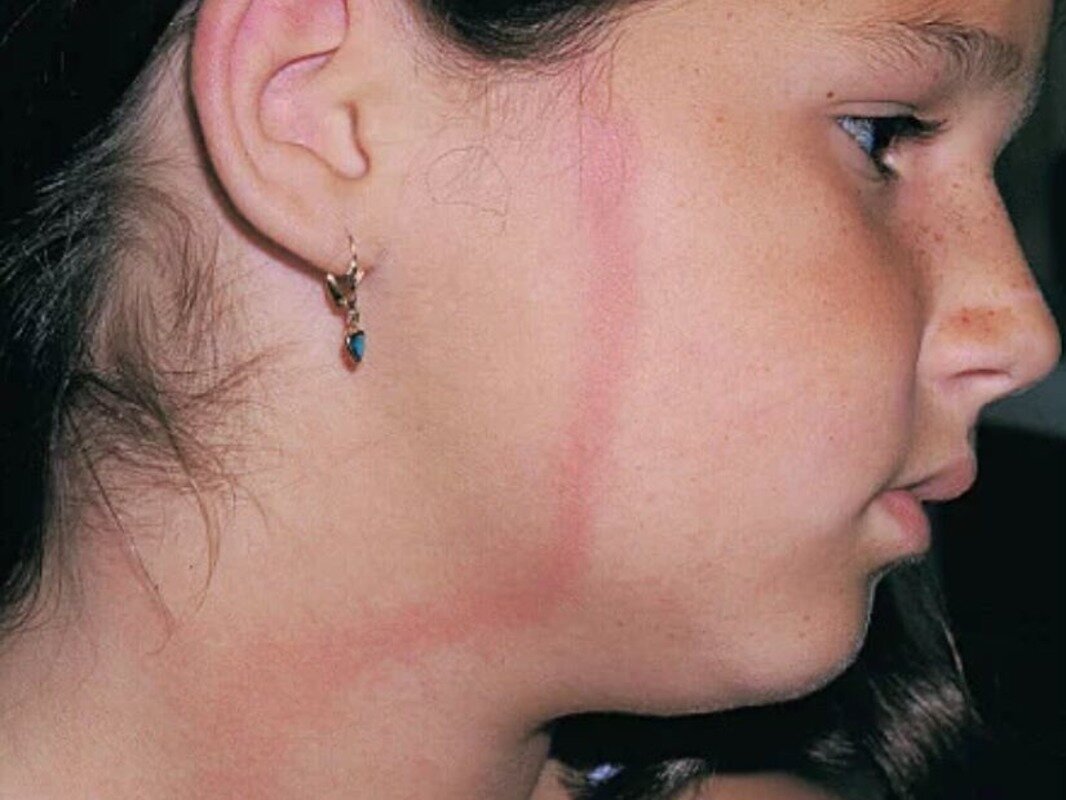 Мигрирующая эритема на лице