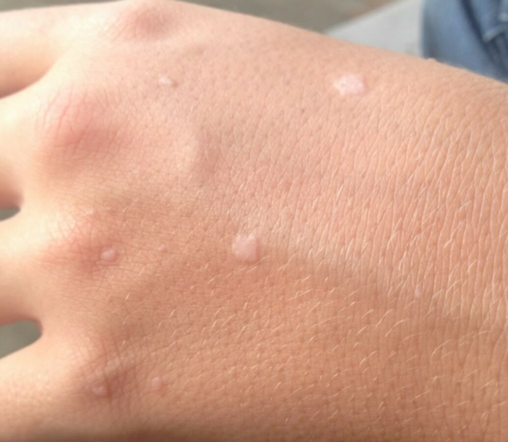 плоские папилломы