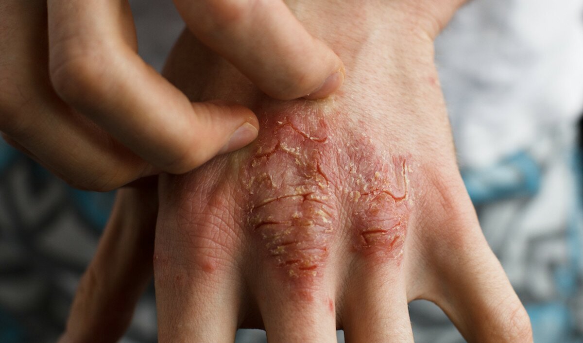 атопічний дерматит на руках