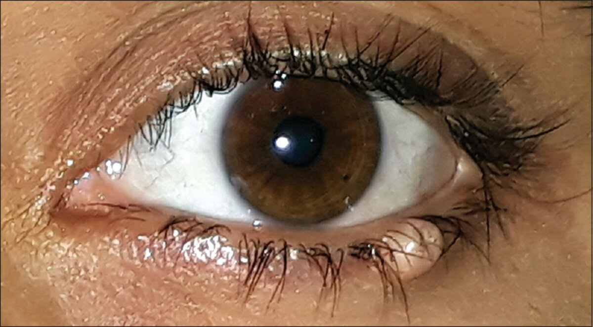 контагіозний молюск очей