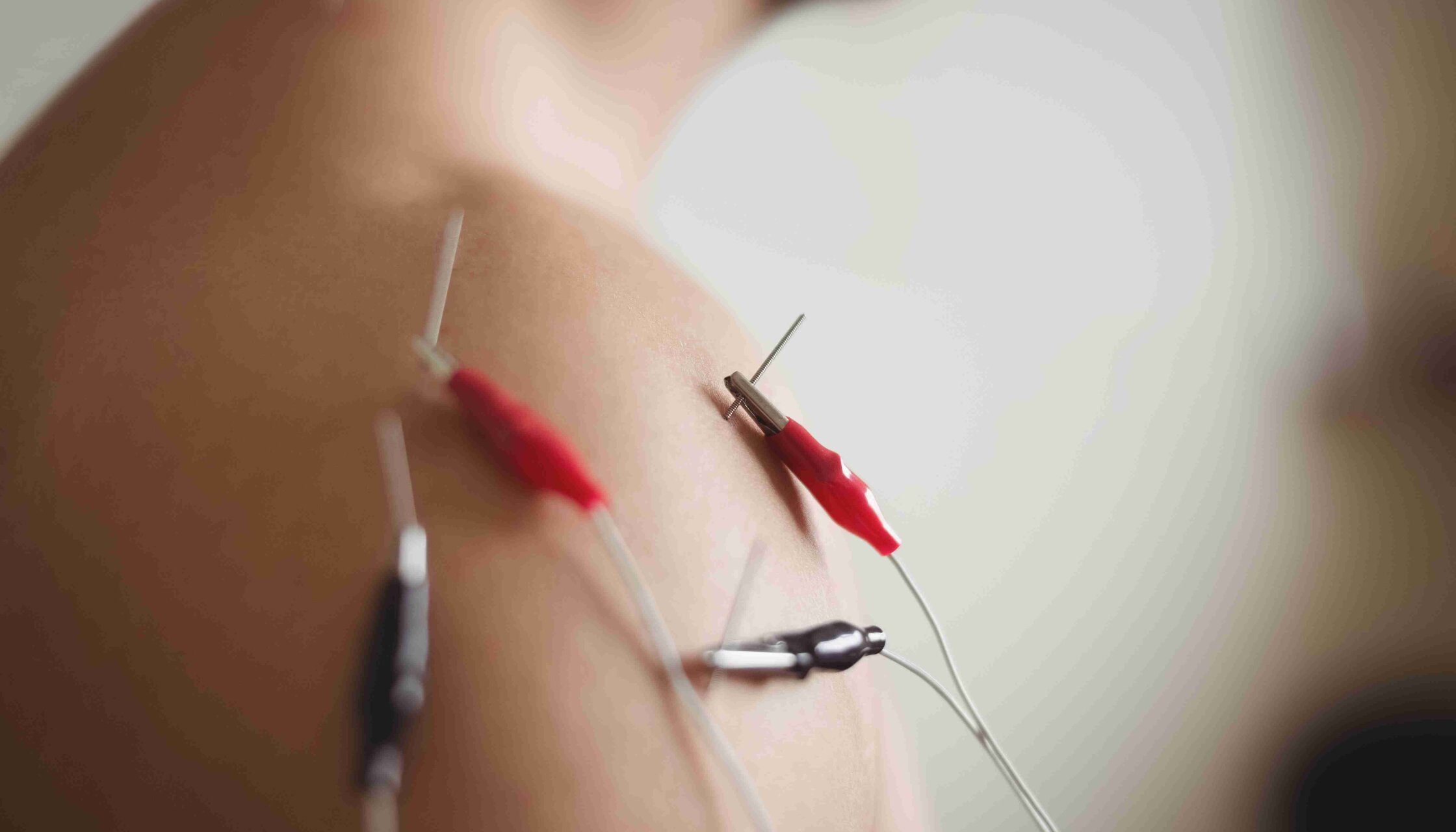 Нова послуга — голкова електронейроміографія в «ОН Клінік Харків» (м. Ярослава Мудрого)