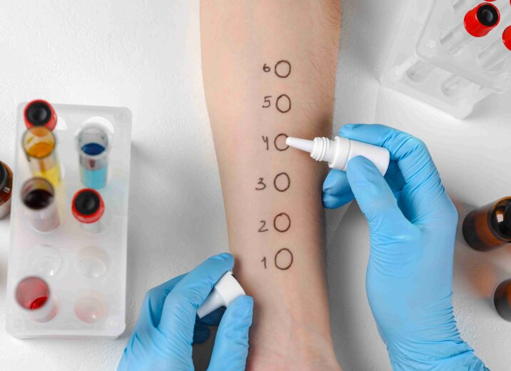 В «ОН Клиник Днепр» начало работу отделение аллергологии