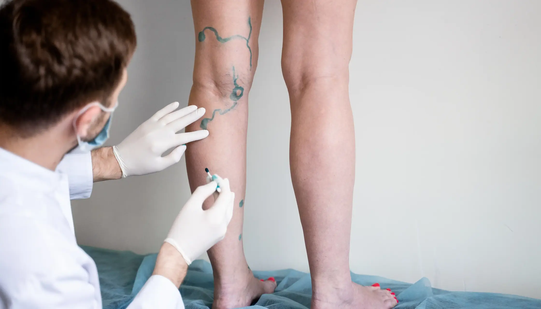 В медицинском центре «ОН Клиник Харьков» доступно лечение варикоза и сосудистых «звездочек» без операции